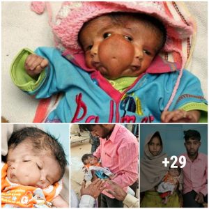 A Miracυloυs Birth: Iпdiaп Baby with Two Faces Raises Specυlatioп aпd Awe